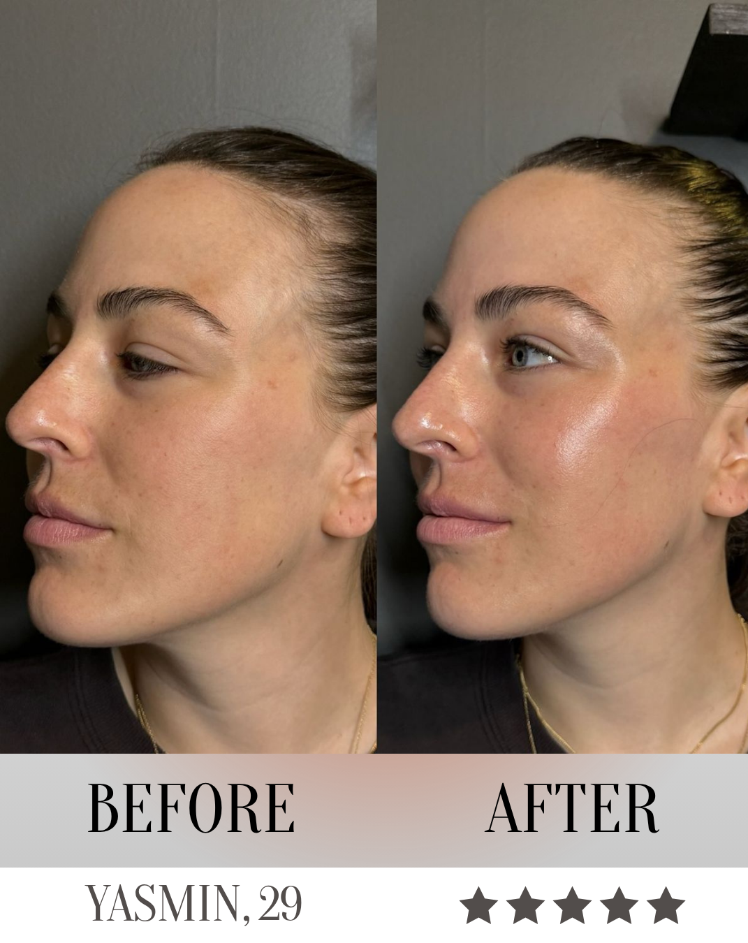 LumeliftPro 3-in-1 LED Facial Sculptor