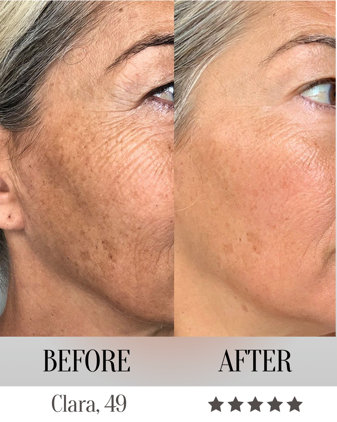 LumeliftPro 7-in-1 LED Face Mask