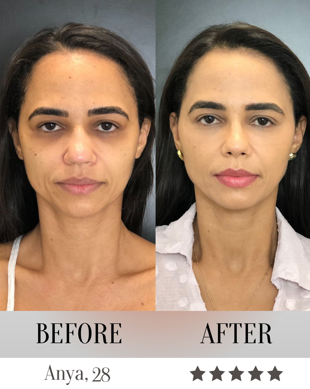 LumeliftPro Red Light Under-Eye Glasses